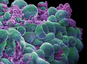 Cellule cancerogene al seno